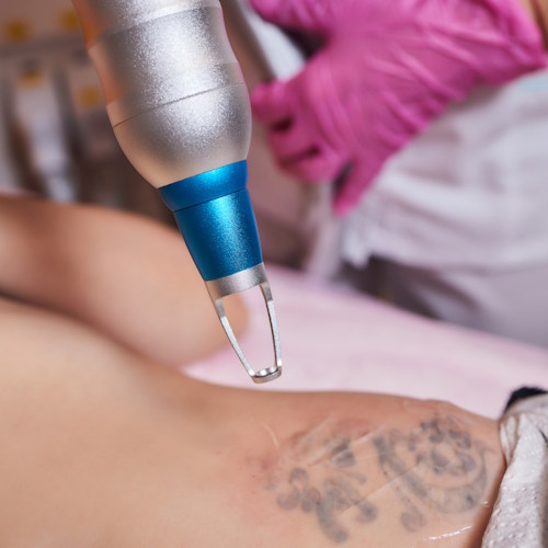 laserowe usuwanie tatuażu Wrocław